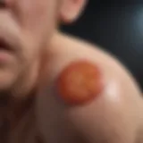 Topical treatment application on a blister